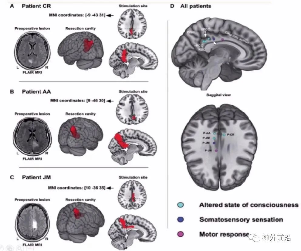 Cingulate Cortex Epilepsy and Surgical Treatment