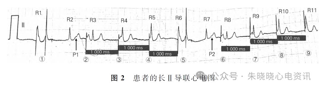 Competition Between Intrinsic Rhythm and Pacemaker Rhythm Leading to Misdiagnosis of Pacemaker Dysfunction