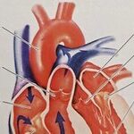 Understanding Pulmonary Valve Regurgitation