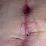 Identification, Assessment, and Classification of Postoperative Wound Dehiscence