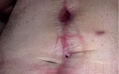 Identification, Assessment, and Classification of Postoperative Wound Dehiscence