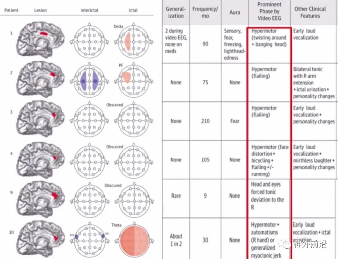 Cingulate Cortex Epilepsy and Surgical Treatment