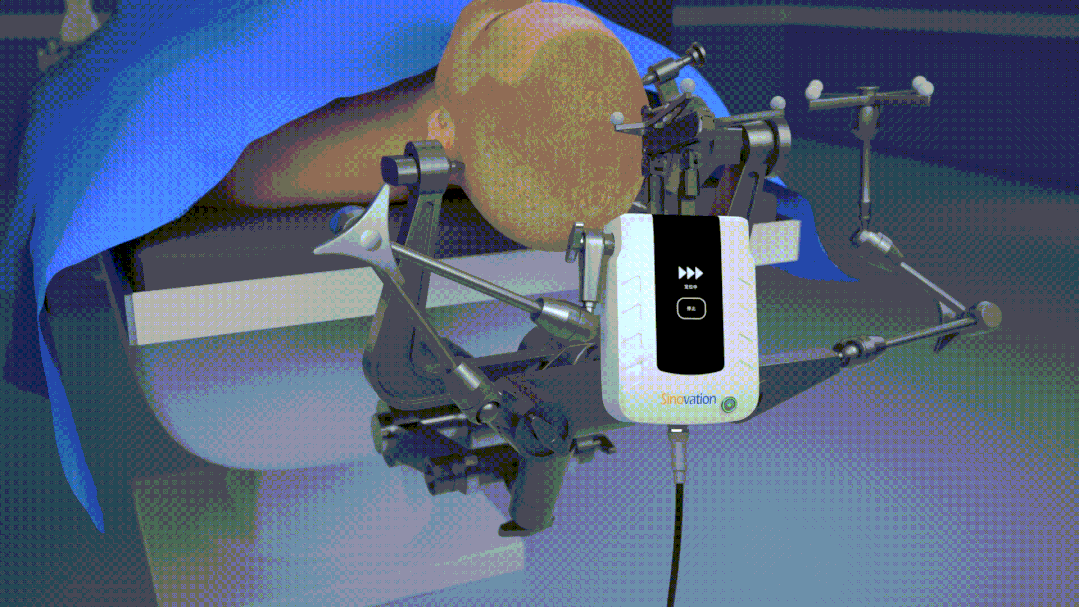 Video Demonstration: Principles and Steps of Q300 Micro Robot-Assisted Hemorrhagic Stroke Puncture Surgery