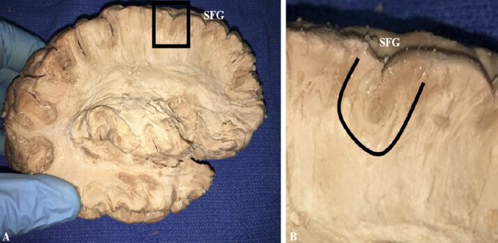 Study of the Superior Frontal Gyrus and Its White Matter Connections