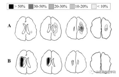 Types of Infarction in Perforating Artery Disease and Advances in Neuroimaging Research