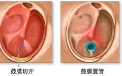 Clinical Study on Retention Time and Recurrence After Tympanostomy in Children