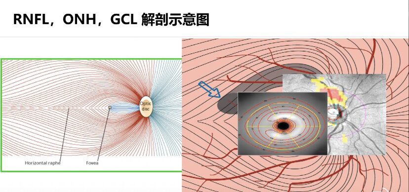 GCC and GCA | Measurement of Ganglion Cell Complex Thickness