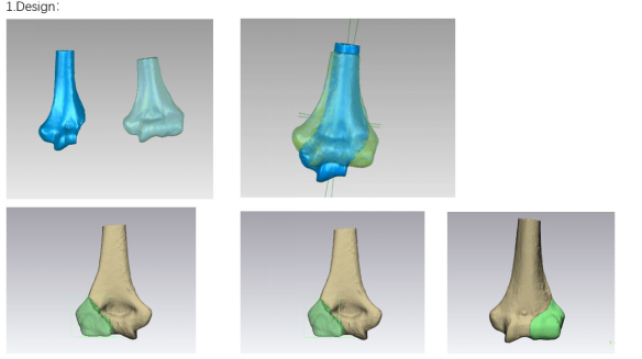 Innovative Uses of 3D Printing in Trauma Orthopedic Surgery