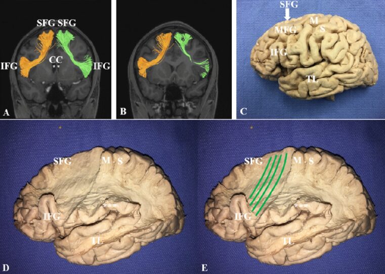 Study of the Superior Frontal Gyrus and Its White Matter Connections