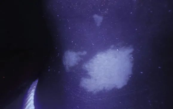 What to Consider for Children with Vitiligo Undergoing SWD Skin Grafting in Switzerland