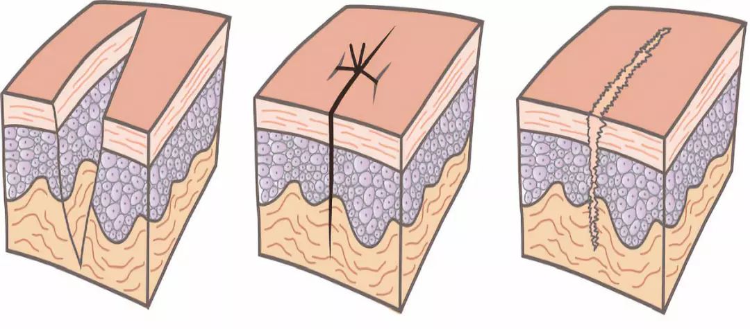 Management of Postoperative Wound Dehiscence by Grade