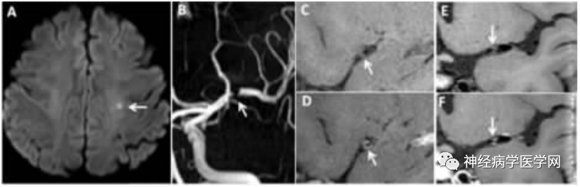 Types of Infarction in Perforating Artery Disease and Advances in Neuroimaging Research