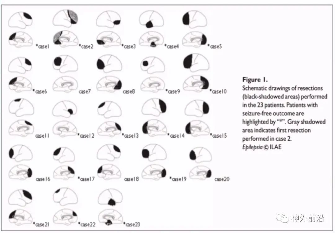 Cingulate Cortex Epilepsy and Surgical Treatment