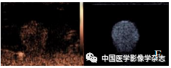 Inhibition of Breast Cancer Cells by Novel Nanoparticles Combined with Low-Intensity Focused Ultrasound