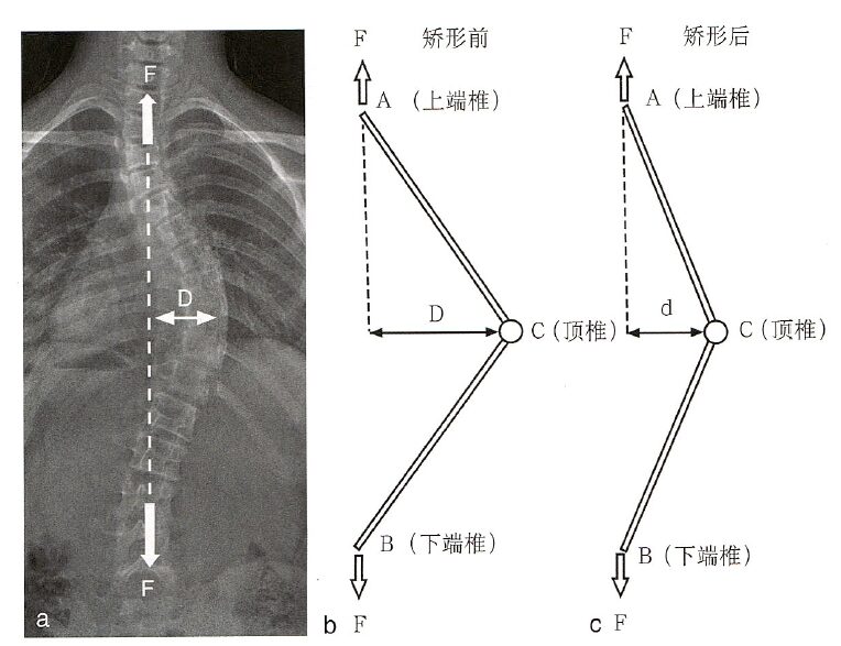 Biomechanics of Spinal Deformities