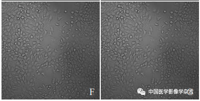 Inhibition of Breast Cancer Cells by Novel Nanoparticles Combined with Low-Intensity Focused Ultrasound