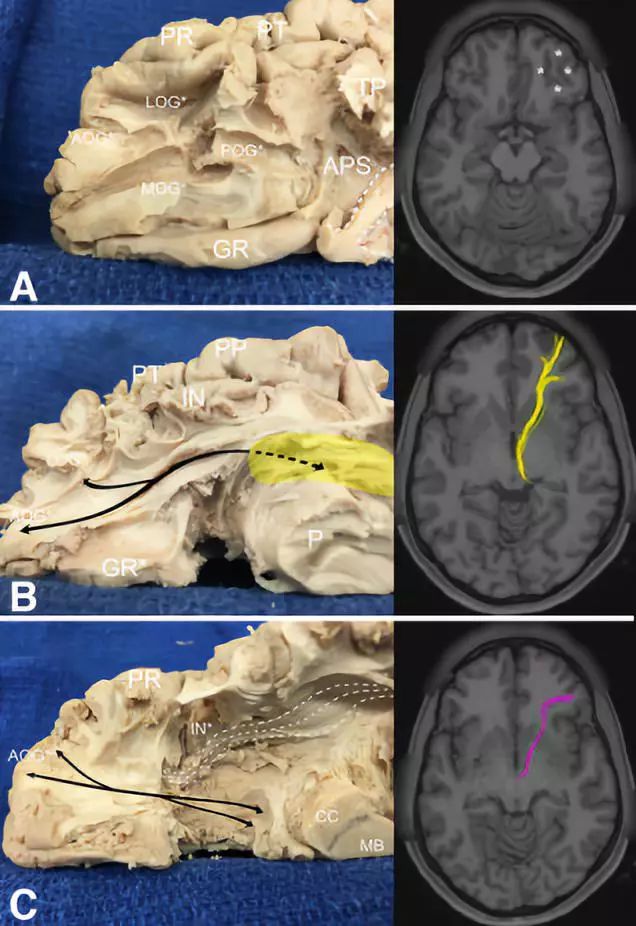 The Anatomical Significance of Brain White Matter Tracts