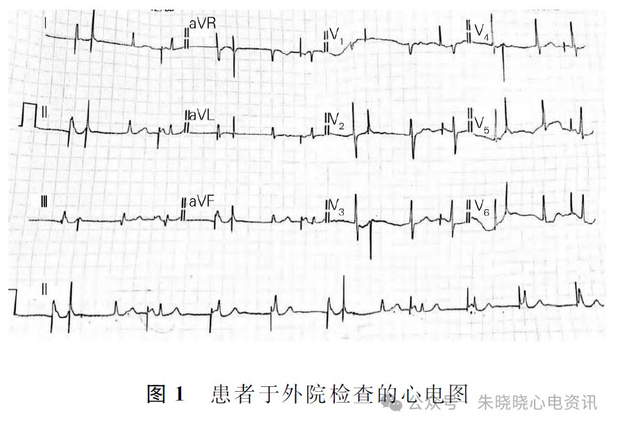 Competition Between Intrinsic Rhythm and Pacemaker Rhythm Leading to Misdiagnosis of Pacemaker Dysfunction
