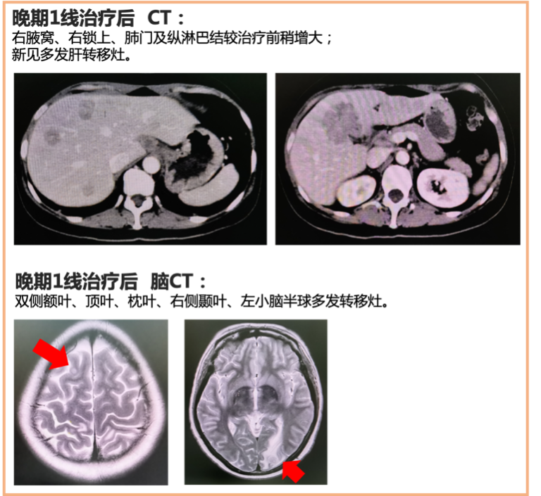 ADC Case Study: Overcoming Metastatic Breast Cancer
