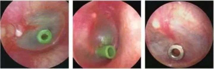 The Past and Present of Secretory Otitis Media in Children