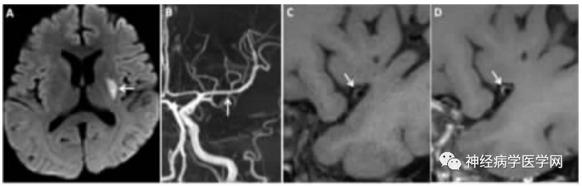 Types of Infarction in Perforating Artery Disease and Advances in Neuroimaging Research
