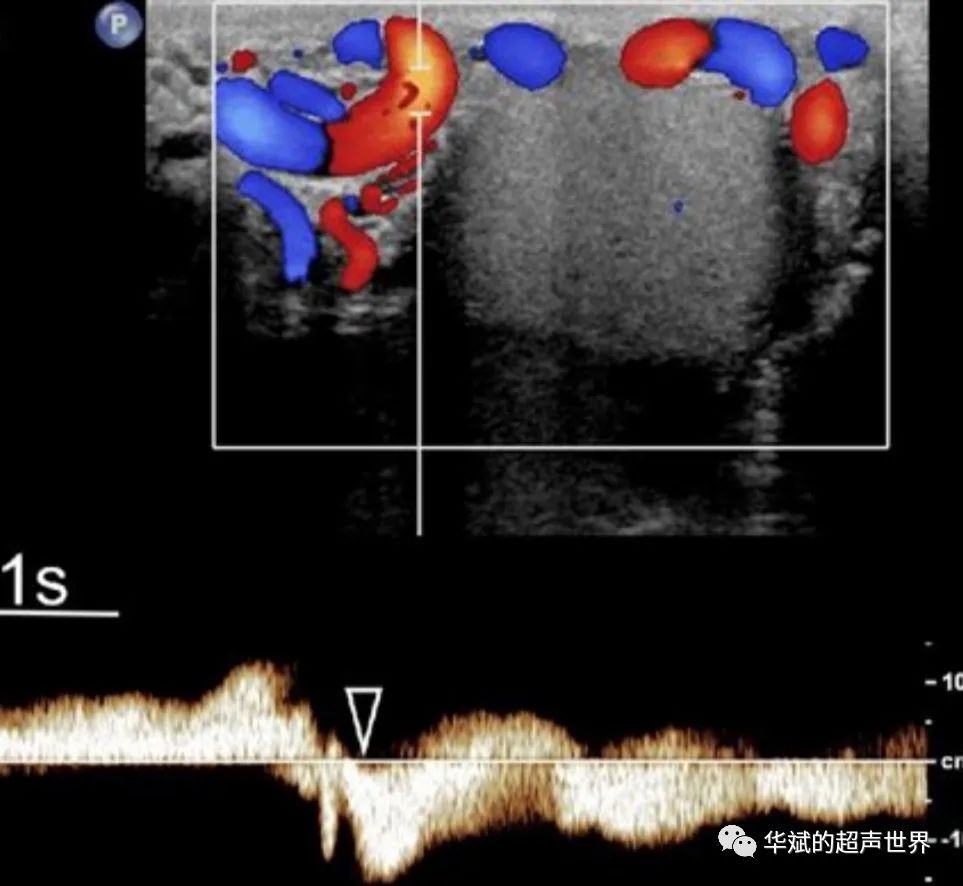 Guidelines for Ultrasound Evaluation of Varicoceles