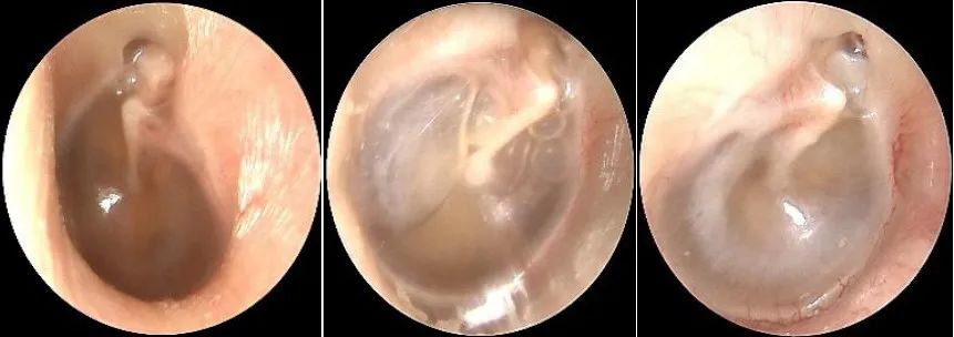 The Past and Present of Secretory Otitis Media in Children