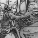 Types of Infarction in Perforating Artery Disease and Advances in Neuroimaging Research