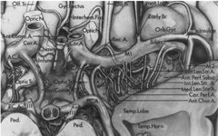Types of Infarction in Perforating Artery Disease and Advances in Neuroimaging Research
