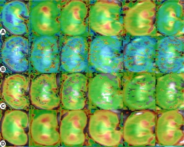 High-Order Diffusion Models in MRI