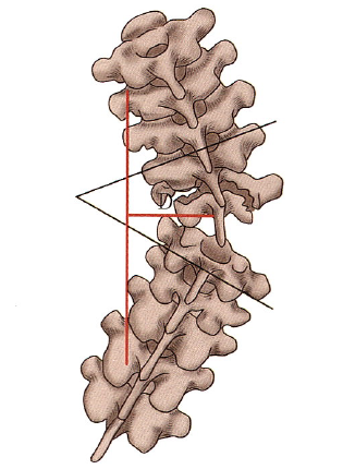 Biomechanics of Spinal Deformities