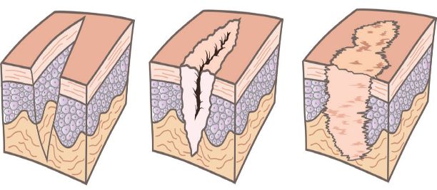 Management of Postoperative Wound Dehiscence by Grade