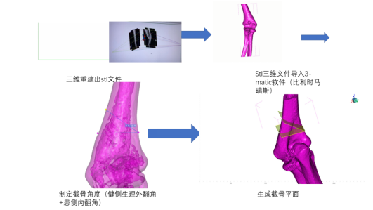 Innovative Uses of 3D Printing in Trauma Orthopedic Surgery