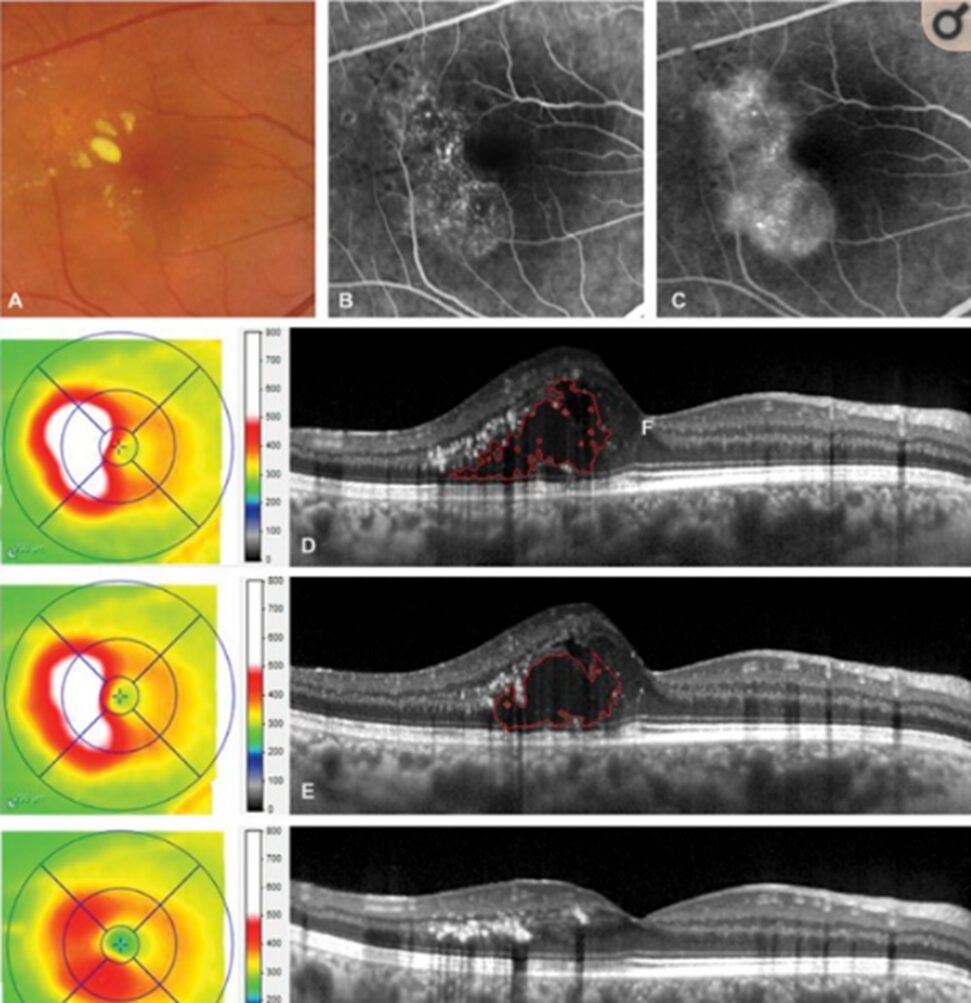 Professor Chen Juan: A Case of Unusual Pediatric Macular Degeneration
