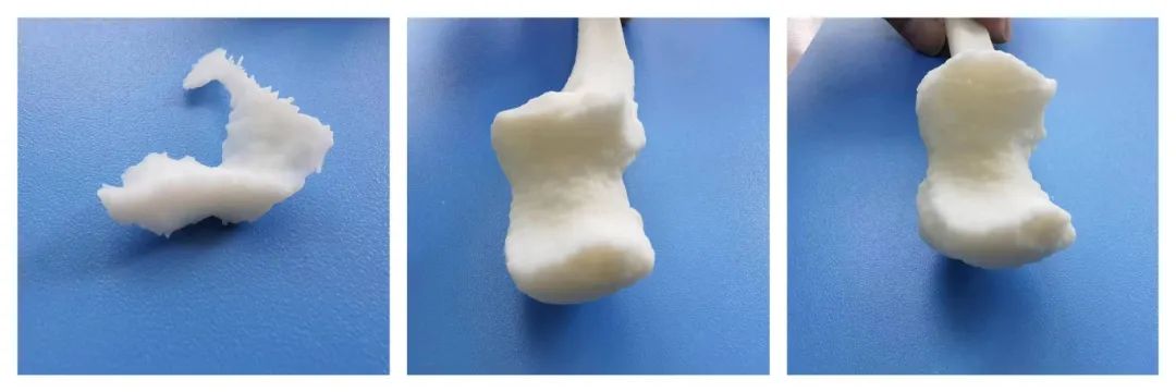 3D Printing Technology for Precise Treatment of Severe Fractures