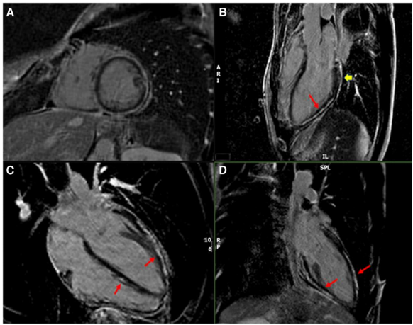 Desmoplakin Cardiomyopathy Mimicking Viral Myocarditis