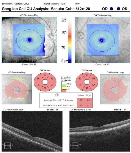 GCC and GCA | Measurement of Ganglion Cell Complex Thickness