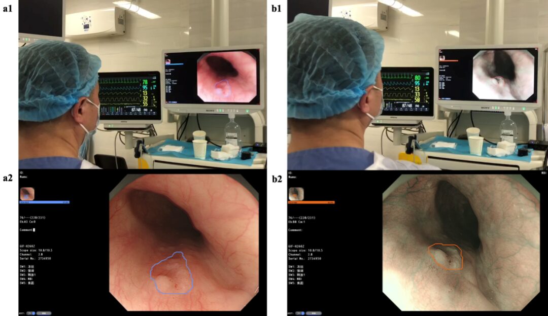 Evaluation of AI-Assisted Early Esophageal Squamous Cell Carcinoma Diagnosis