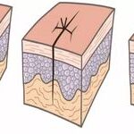 Management of Postoperative Wound Dehiscence by Grade