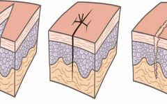 Management of Postoperative Wound Dehiscence by Grade