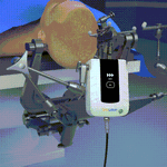 Video Demonstration: Principles and Steps of Q300 Micro Robot-Assisted Hemorrhagic Stroke Puncture Surgery