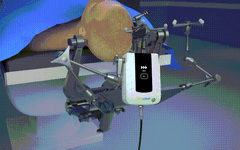 Video Demonstration: Principles and Steps of Q300 Micro Robot-Assisted Hemorrhagic Stroke Puncture Surgery