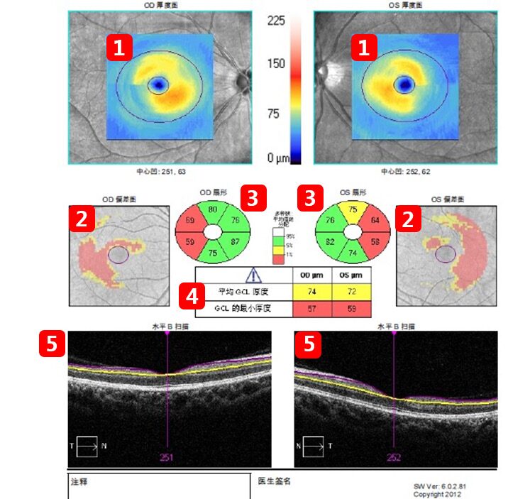 GCC and GCA | Measurement of Ganglion Cell Complex Thickness