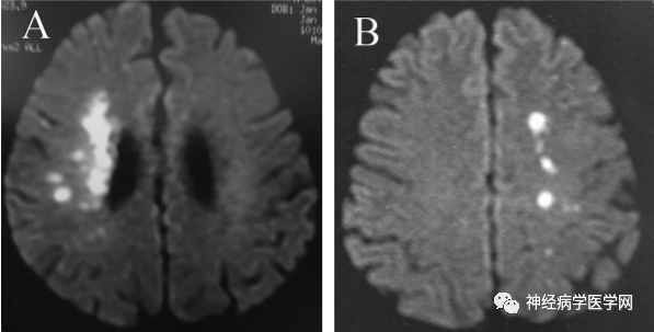Types of Infarction in Perforating Artery Disease and Advances in Neuroimaging Research