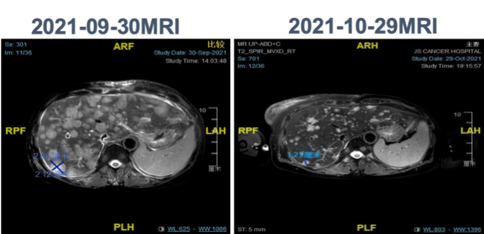 Case Sharing of ADC: A HER2-Positive Breast Cancer Case