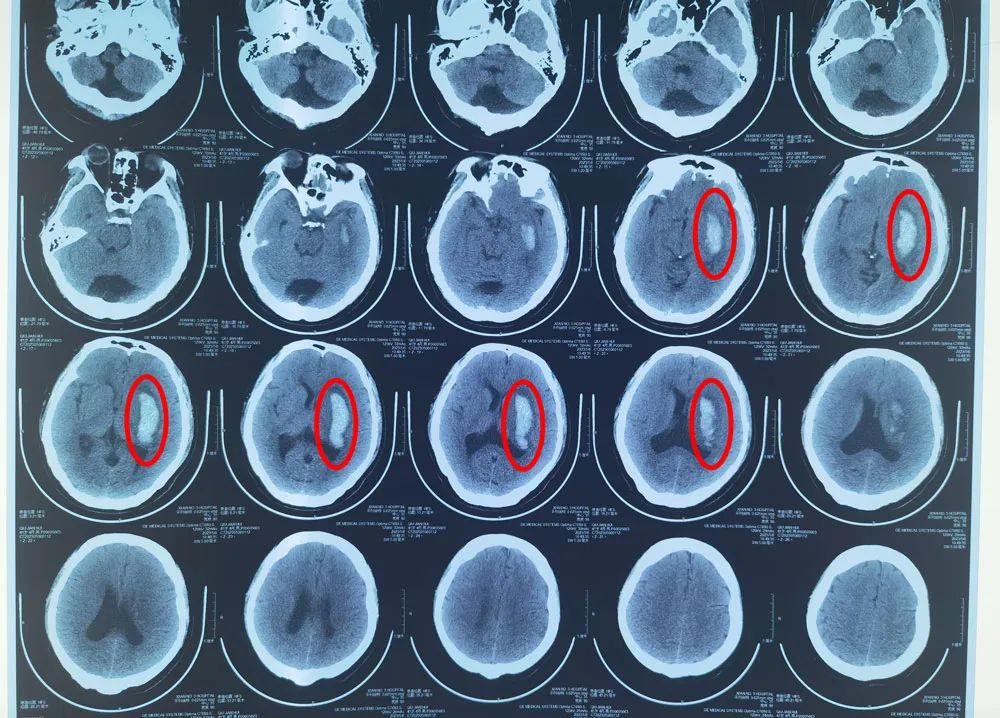 Precision Treatment: Micro-Robots Revolutionizing Neurosurgery