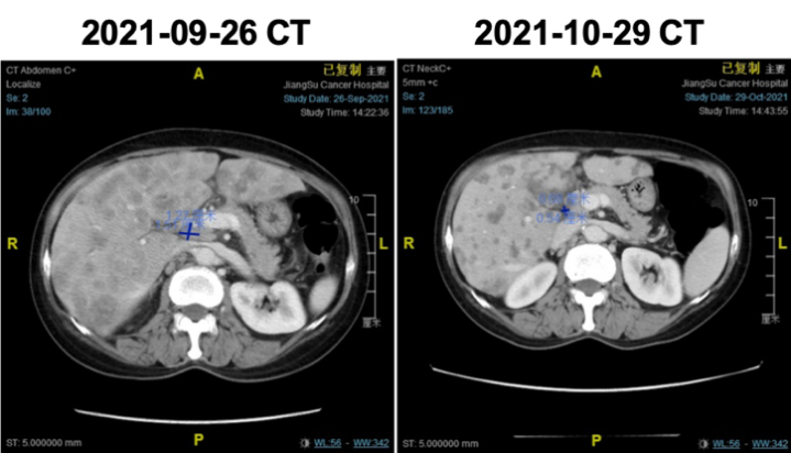 Case Sharing of ADC: A HER2-Positive Breast Cancer Case