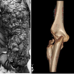 Innovative Uses of 3D Printing in Trauma Orthopedic Surgery
