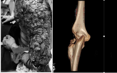 Innovative Uses of 3D Printing in Trauma Orthopedic Surgery