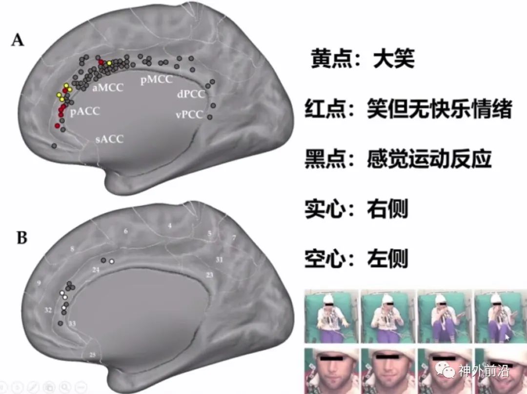 Cingulate Cortex Epilepsy and Surgical Treatment